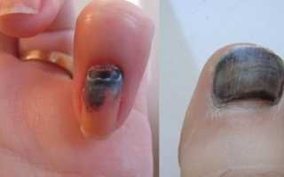 Как лечить палец после удара молотком