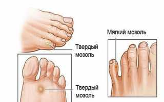 Мозоль между пальцами ног – лечение, как избавиться