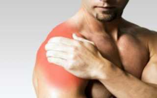 Насколько эффективен бандаж при вывихе плеча?